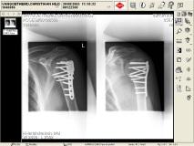 banana's armafter crash last year with my s4r